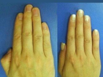 Observe el lector, que en la mano de los hombres el dedo índice y el anular tienen alturas diferentes y los mismos dedos en la mano de una mujer ambos son de tamaño similar.
